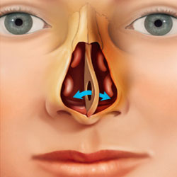 Septal Perforation Raleigh Capitol Sinus Allergy Center